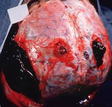 Epidural hematoma, Epidural hematoma