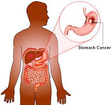 இந்தியர்களை அதிகம் தாக்கும் புற்றுநோய்!! Stomach-cancer