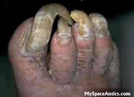 http://tbn3.google.com/images?q=tbn:T23DGZUYL043IM:http://www.myspaceantics.com/images/funny/ugly-toenails.jpg