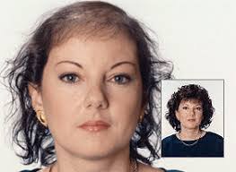 home remedy hair loss garlic