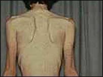Foto di pro anorexia - bbc (uk)