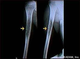 Ewings Sarcoma - X-ray