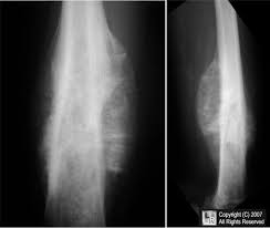 Ewing sarcoma