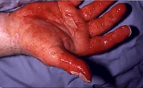 Foto di burn - onlinesurgery