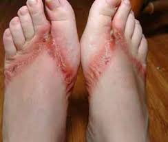 [Bild: flip-flop-rash2.jpg]