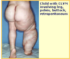  are Klippel-Trenaunay syndrome 