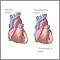 Hypertensive heart disease - 