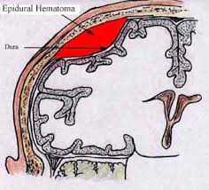 An epidural hematoma forms between