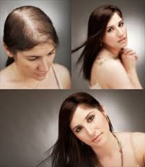 Hair Loss Women Organin