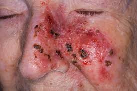 skin cancer
