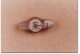 Example of a Mic-Key Button (NO, this is not Chris's belly,  hehehe - www.chrisncrohns.blogspot.com